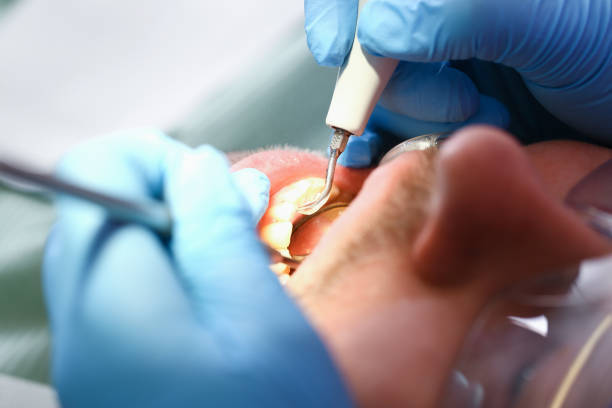 Best Dental Abscess Treatment in Louisvle, IL