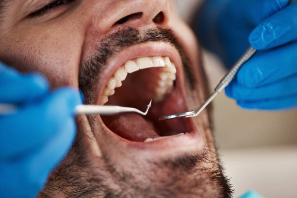 Best Emergency Root Canal Therapy in Louisvle, IL